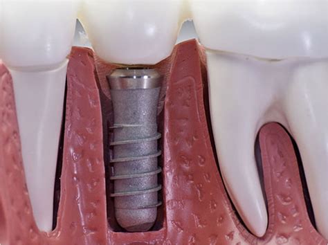  Urethane: Un Materiale Rivoluzionario per Impianti Cardiaci e Protesi Dentali?